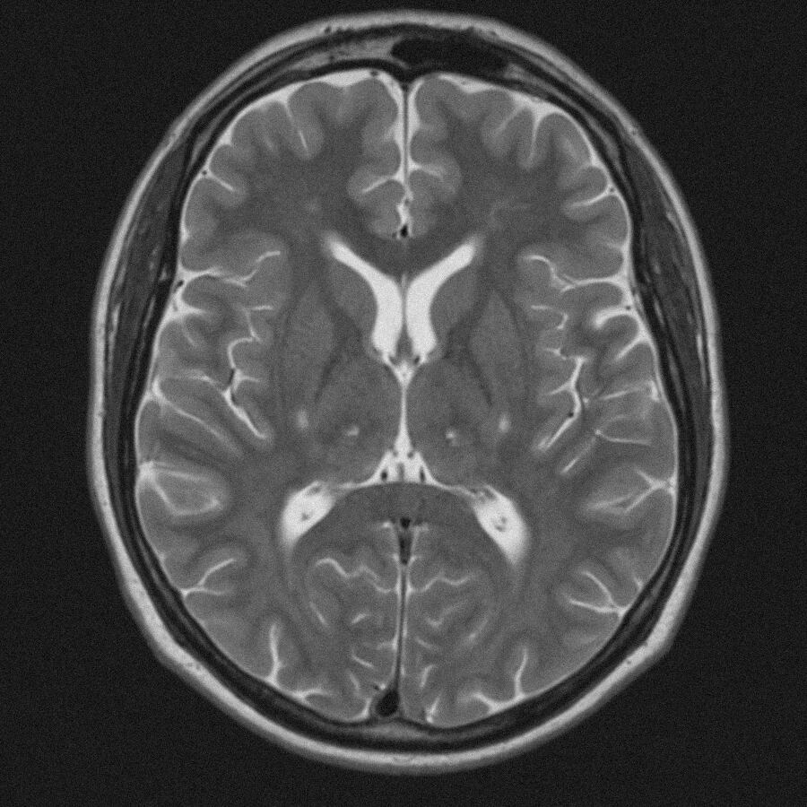 Konwencjonalny obraz MRI mózgu